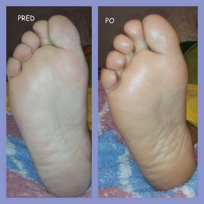 učinek po eni terapiji