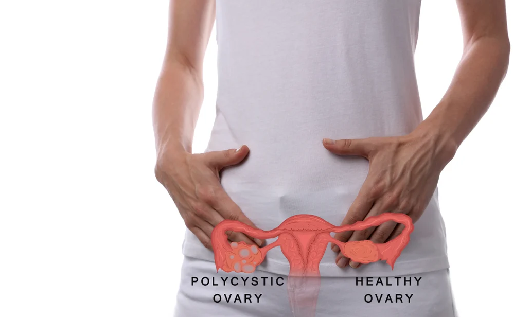 Policistični jajčniki, zanositev